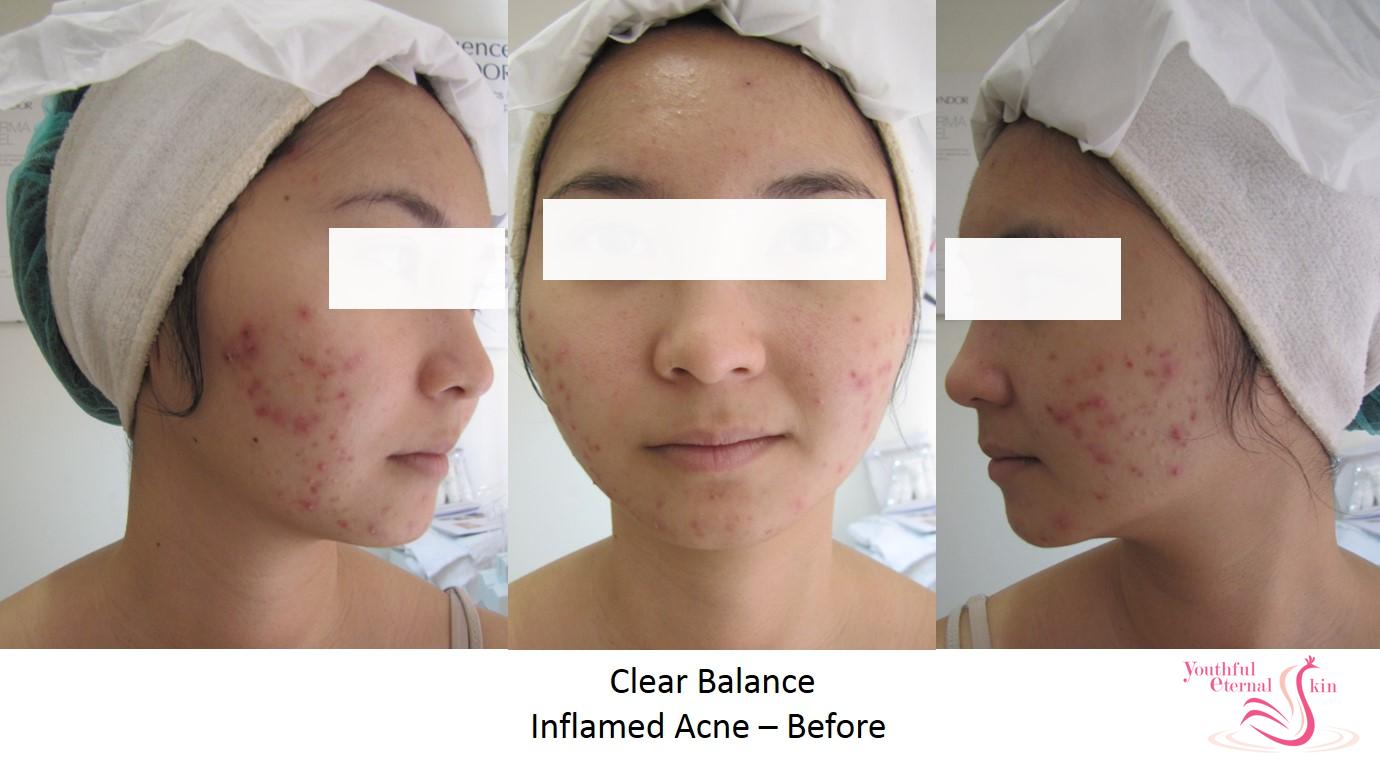 ClearB_Inflamed_Acne_Before