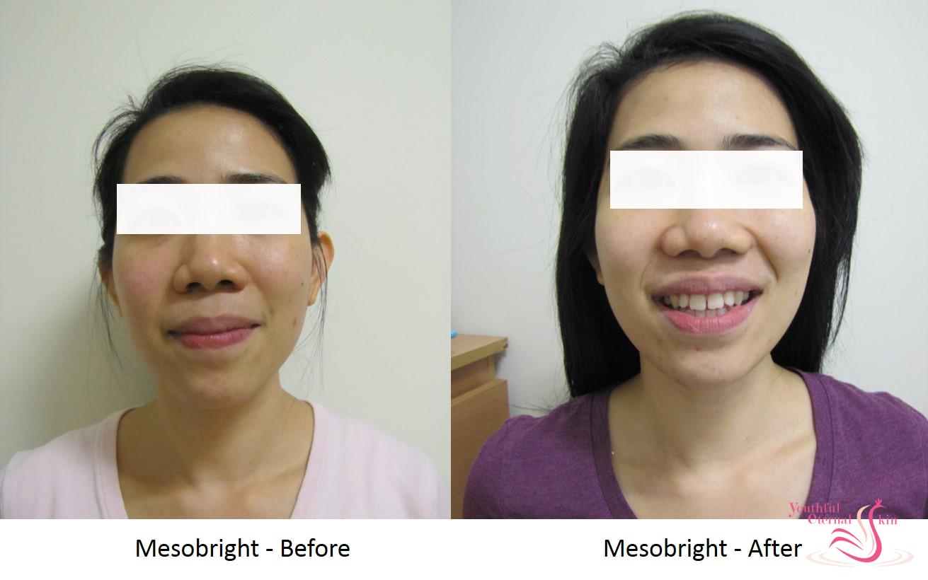 Mesobright_Before__After